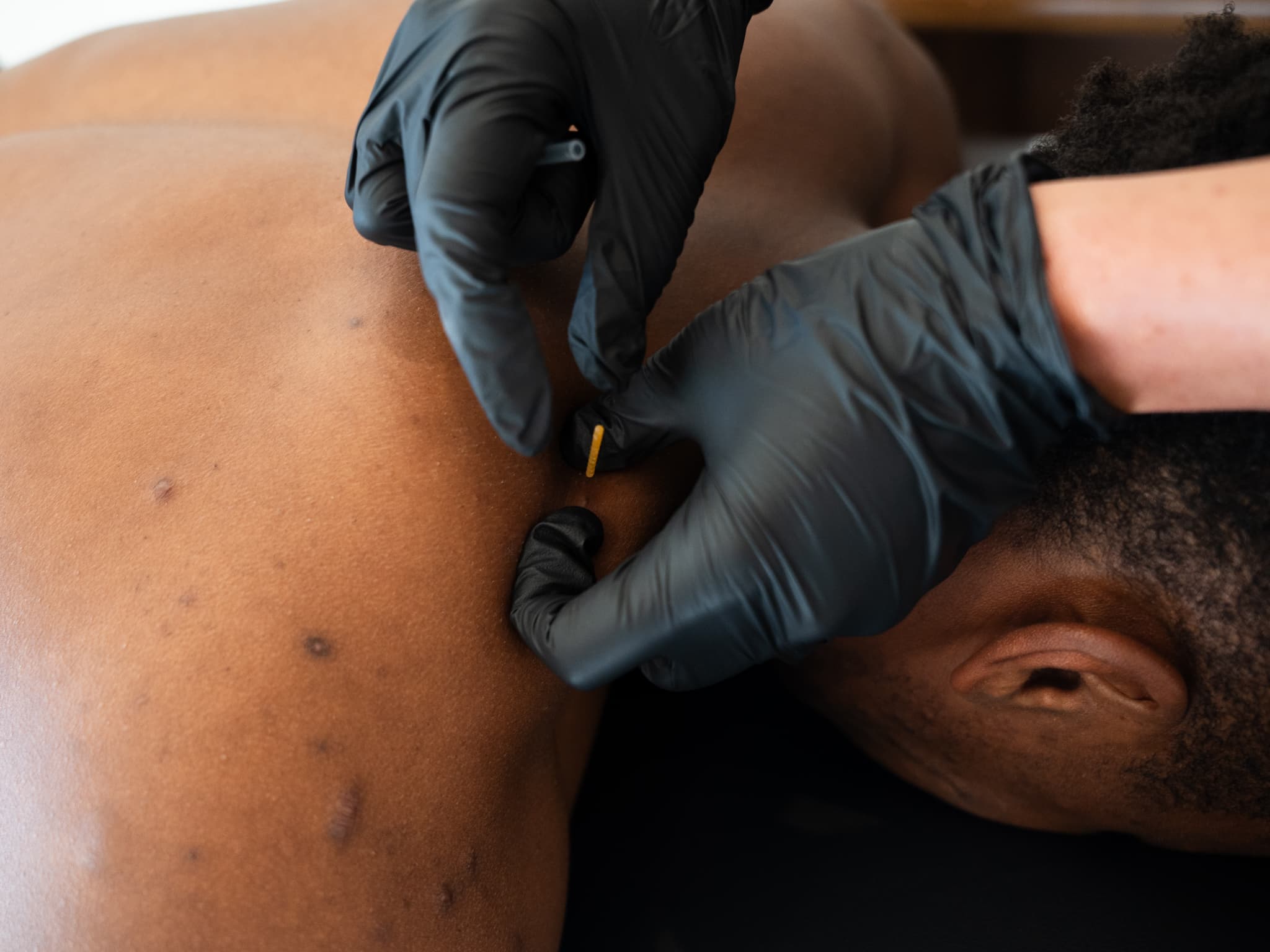 Dry needling therapy close-up