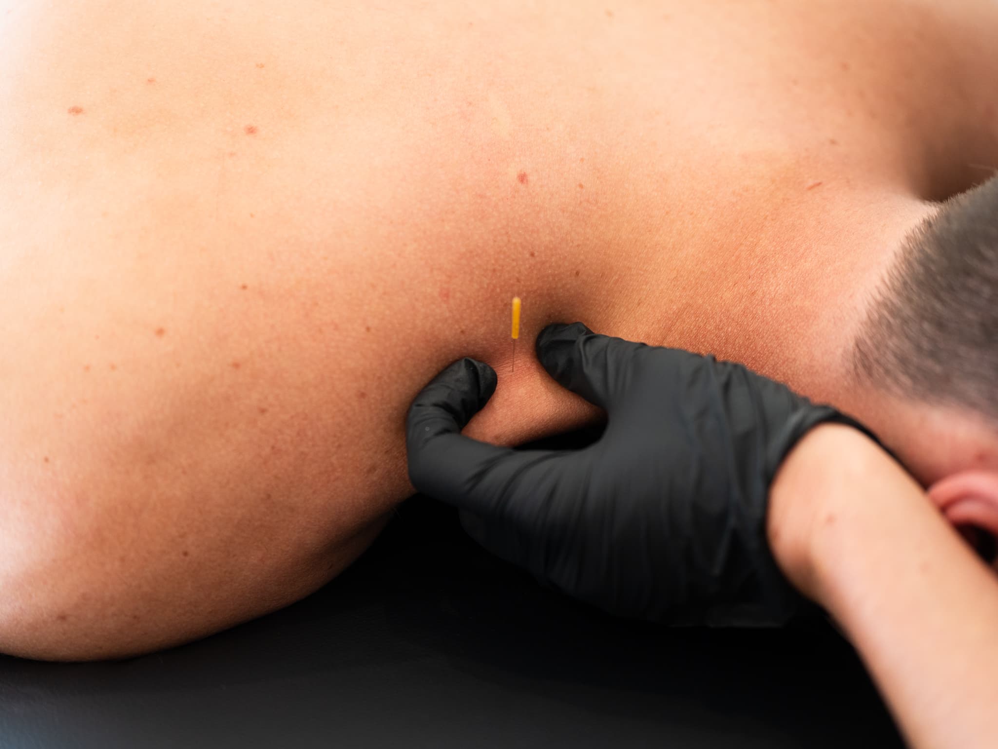 Dry needling therapy demonstration